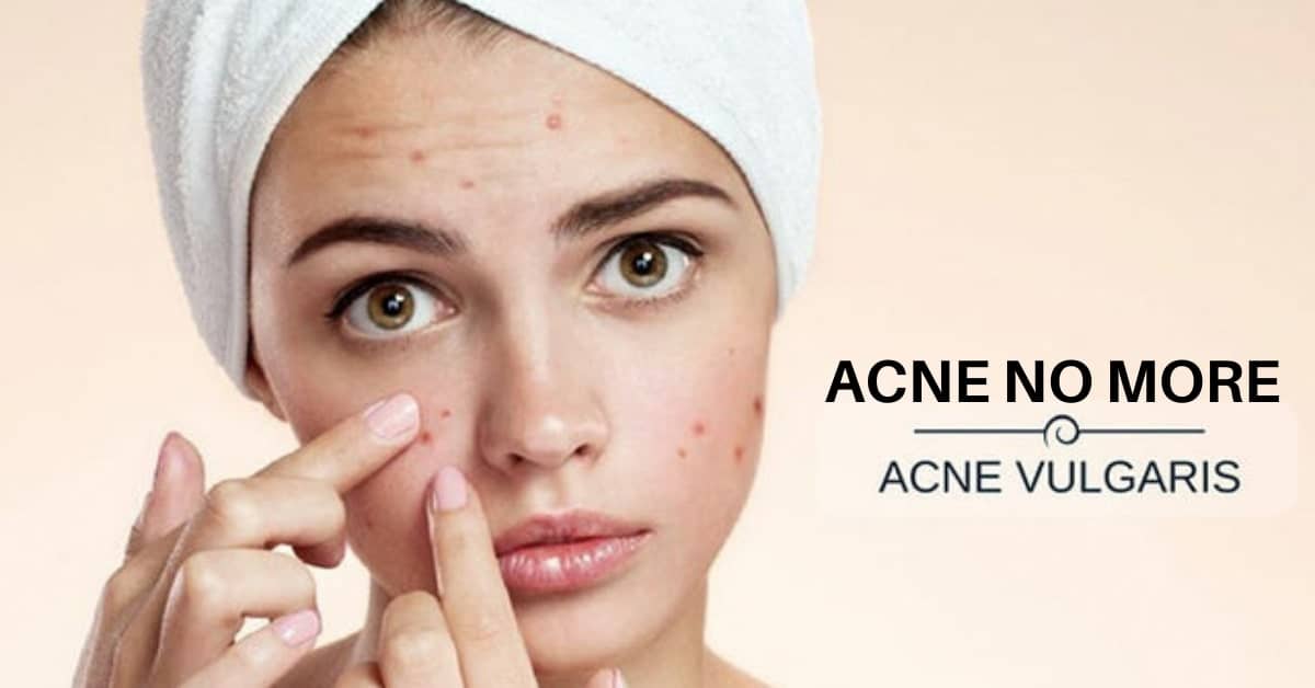 Acne vulgaris